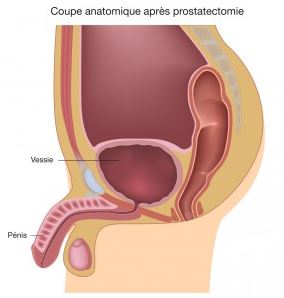 Gaspard Protocole-ProstatectomieApres