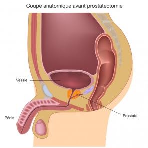 Gaspard Protocole-ProstatectomieAvant